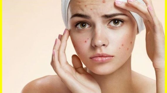 Petunjuk Pemakaian Oxy 10 Acne Treatment